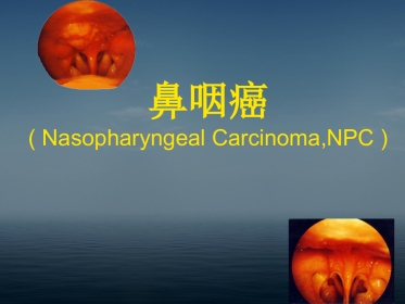 本科生鼻咽癌讲课幻灯PPT教学课件