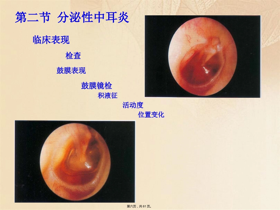 耳鼻咽喉头颈外科学耳部疾病_第6页