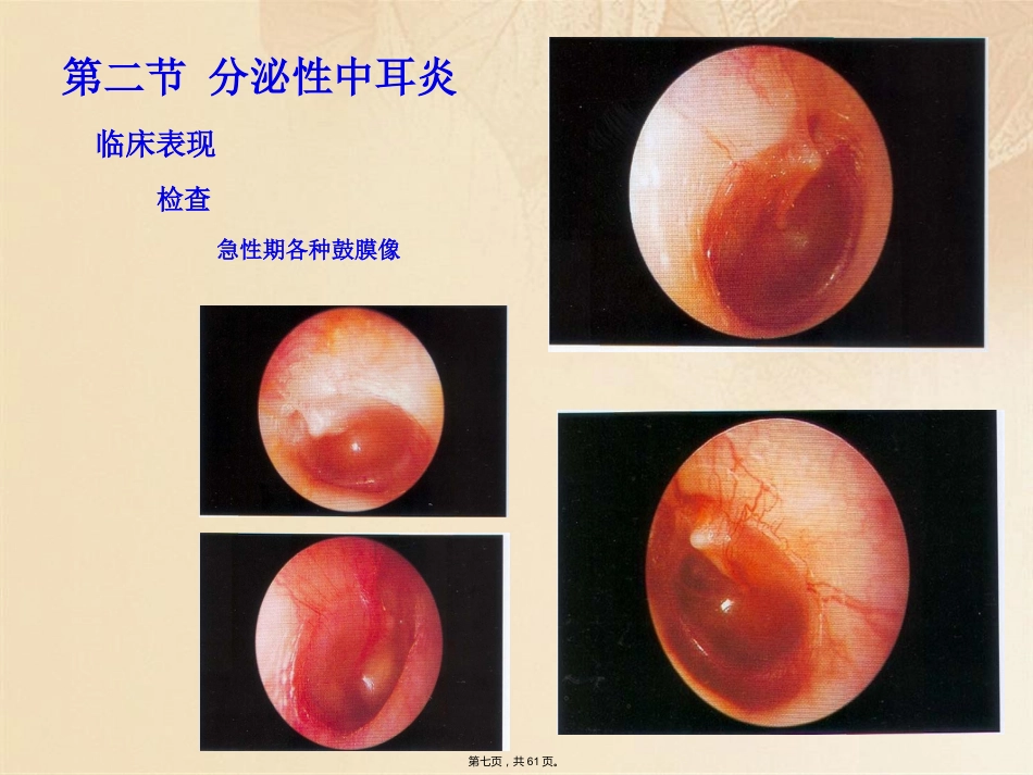 耳鼻咽喉头颈外科学耳部疾病_第7页