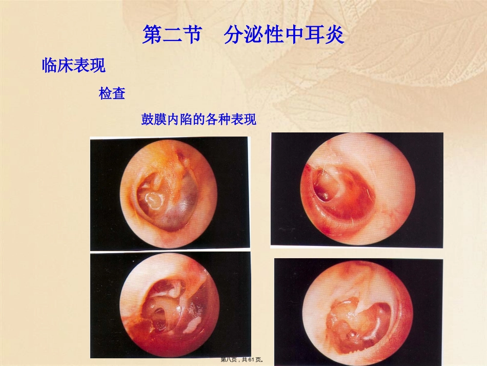 耳鼻咽喉头颈外科学耳部疾病_第8页