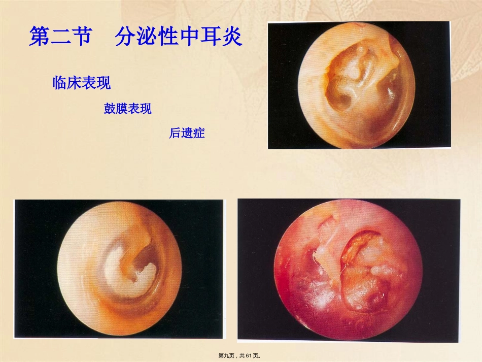 耳鼻咽喉头颈外科学耳部疾病_第9页