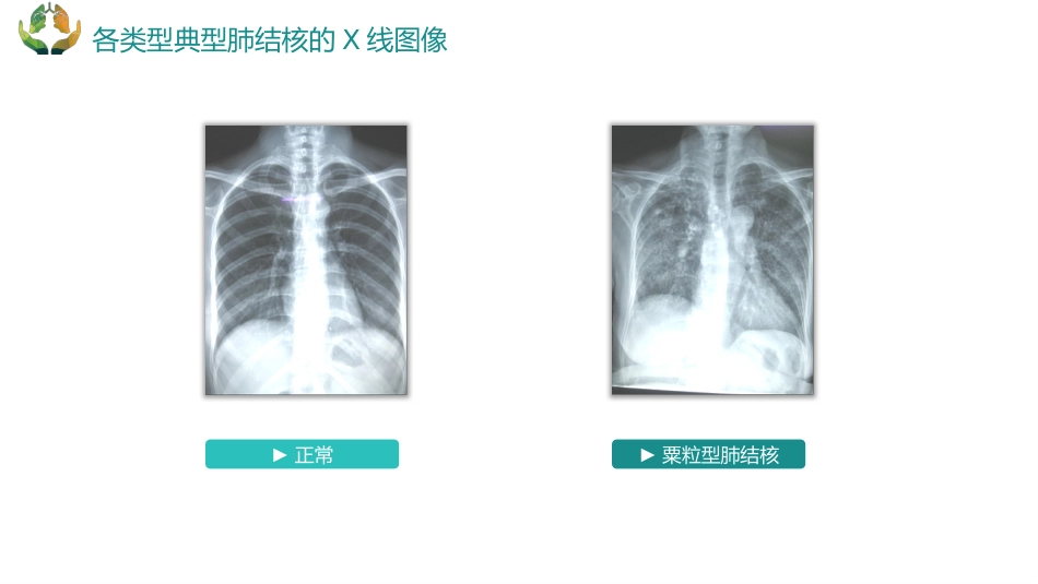 肺结核的护理_第10页