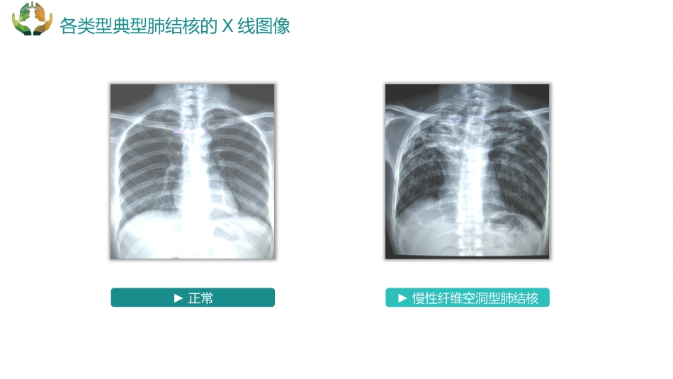 肺结核的护理_第11页
