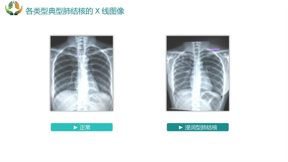 肺结核的护理_第12页