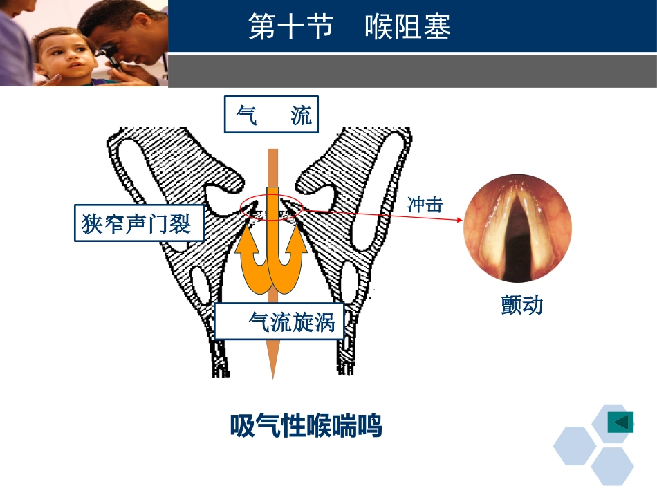 临床医学耳鼻喉科喉阻塞_第15页