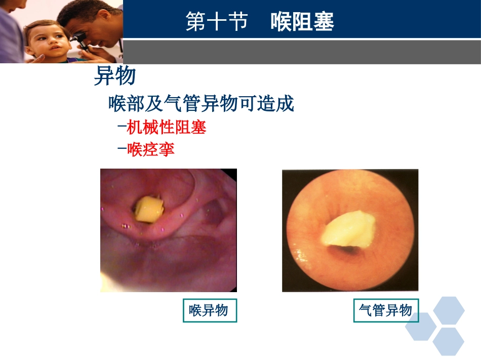 临床医学耳鼻喉科喉阻塞_第8页