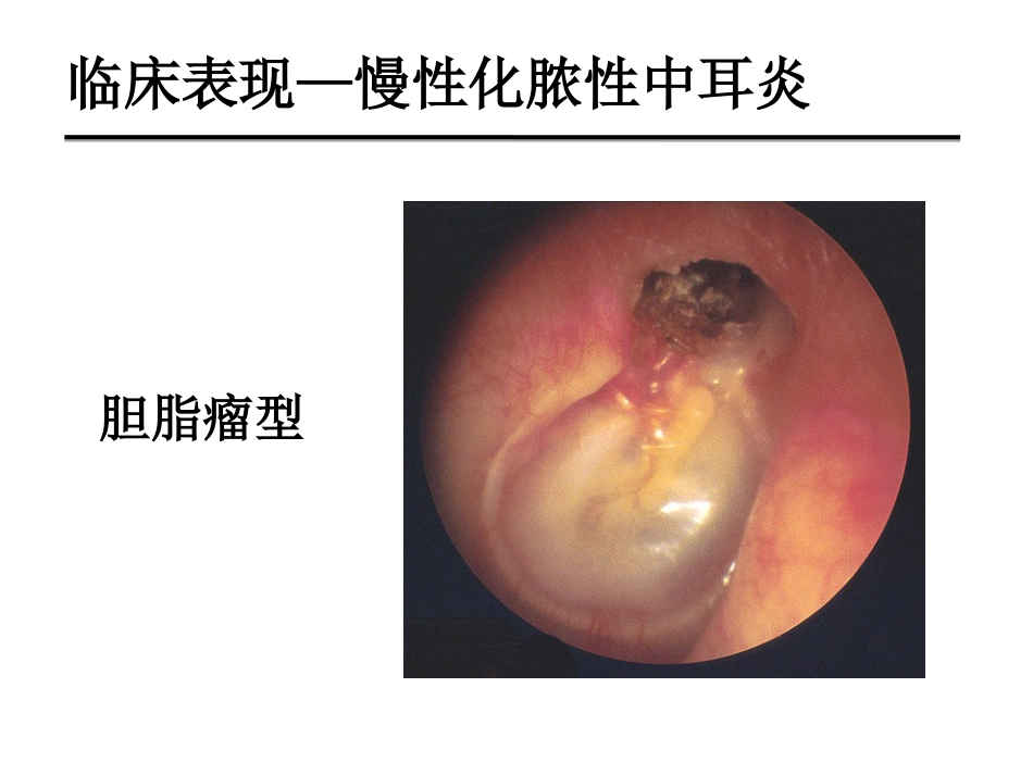 慢性化脓性中耳炎(邱建华)_第10页