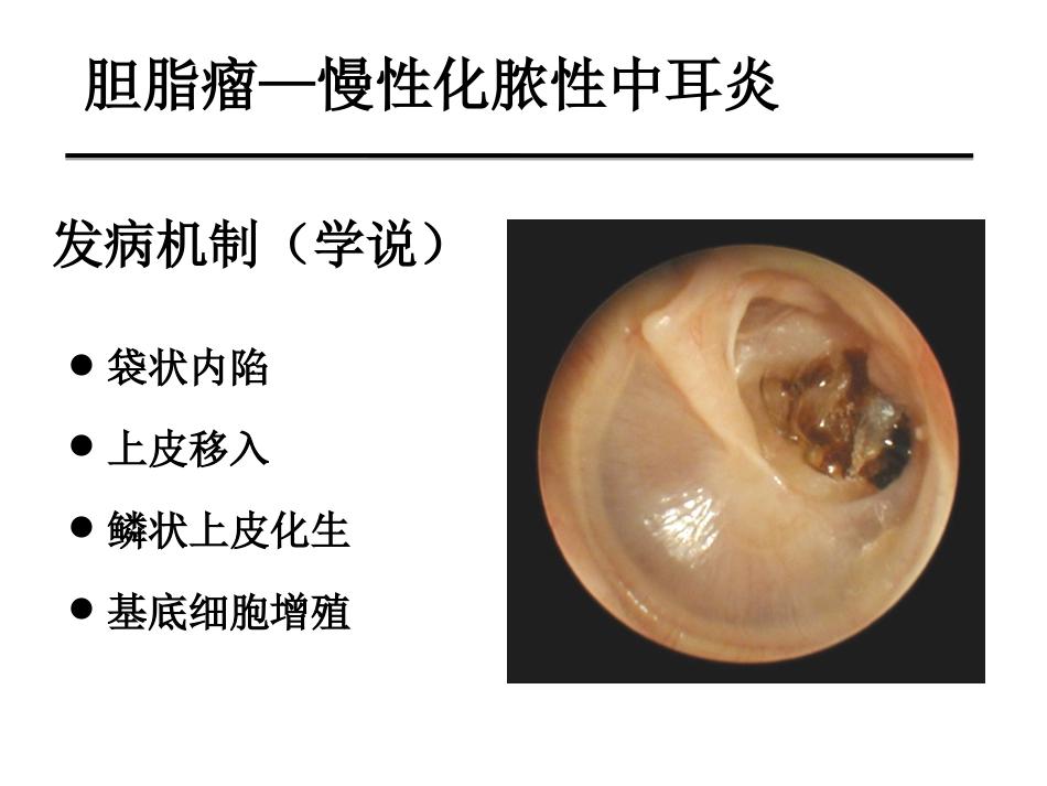 慢性化脓性中耳炎(邱建华)_第12页
