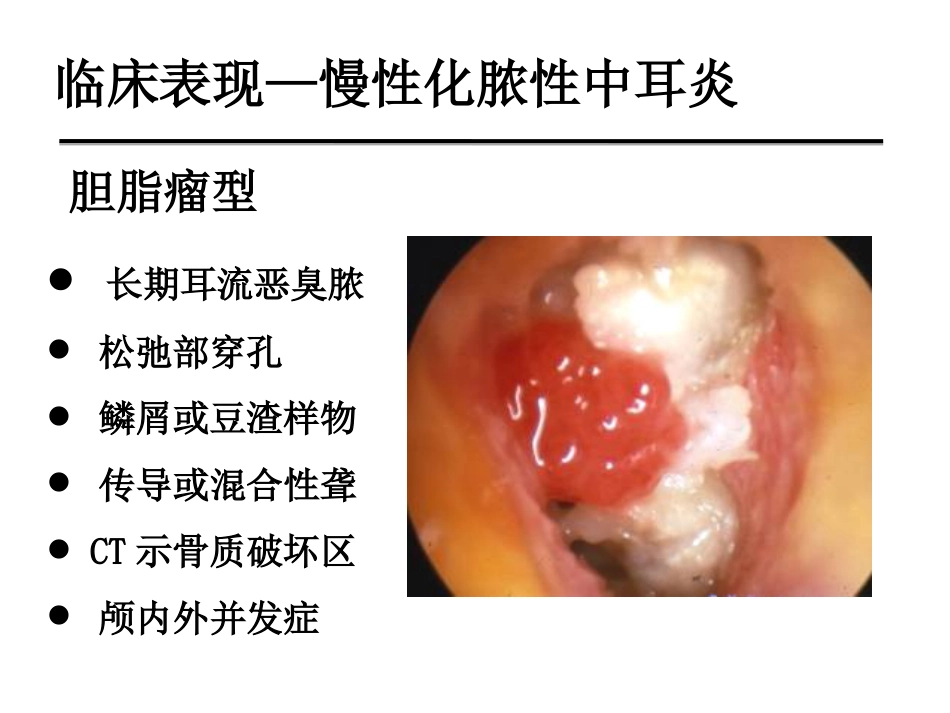 慢性化脓性中耳炎(邱建华)_第13页