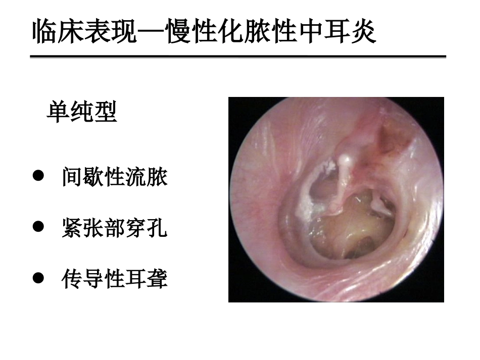 慢性化脓性中耳炎(邱建华)_第8页