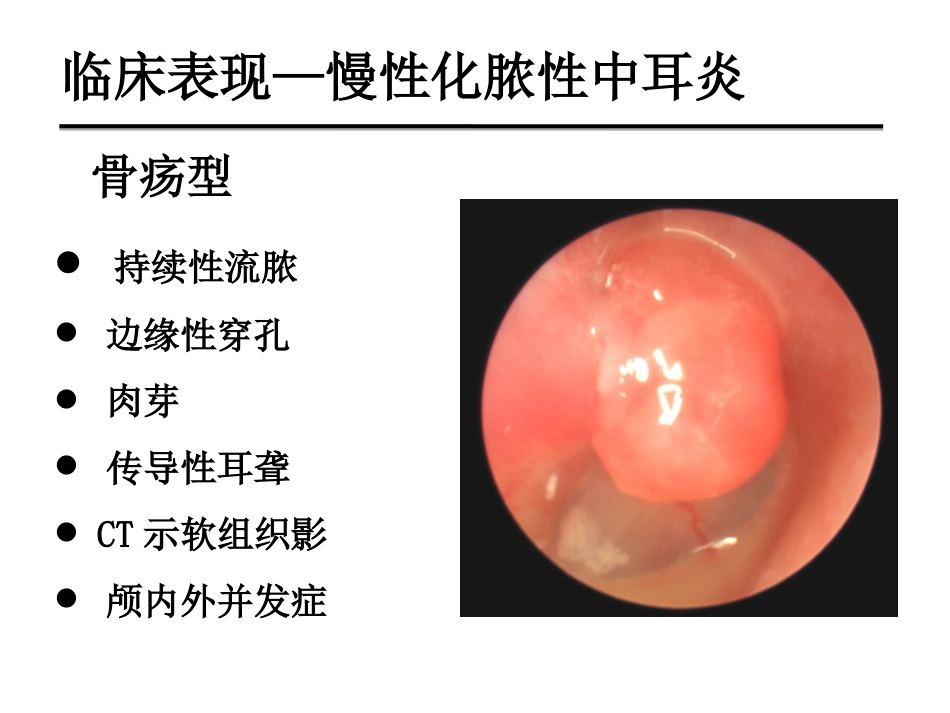慢性化脓性中耳炎(邱建华)_第9页