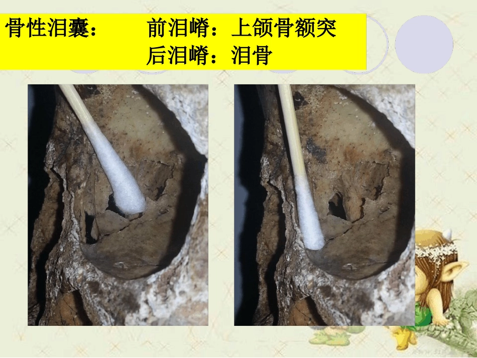 泪道病及鼻内镜下鼻腔泪囊吻合术最新优质PPT课件_第10页