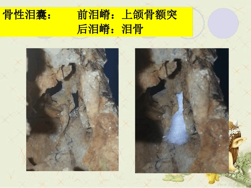 泪道病及鼻内镜下鼻腔泪囊吻合术最新优质PPT课件_第11页