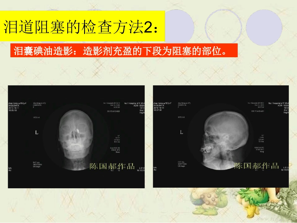 泪道病及鼻内镜下鼻腔泪囊吻合术最新优质PPT课件_第15页