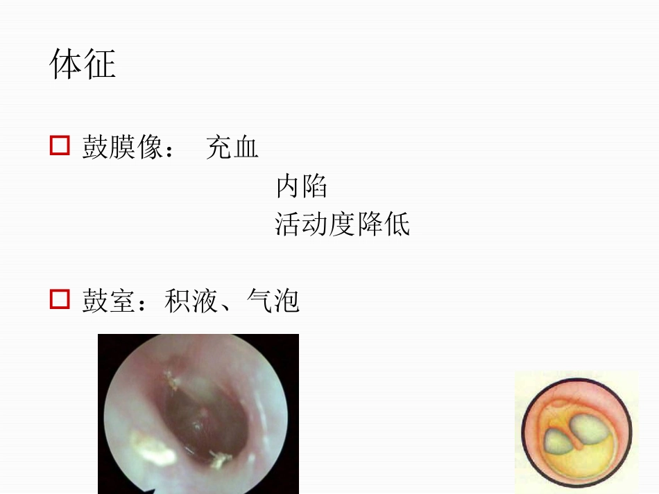 分泌性中耳炎中文_第12页