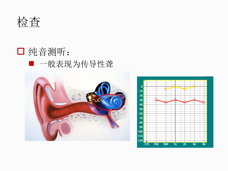 分泌性中耳炎中文_第13页