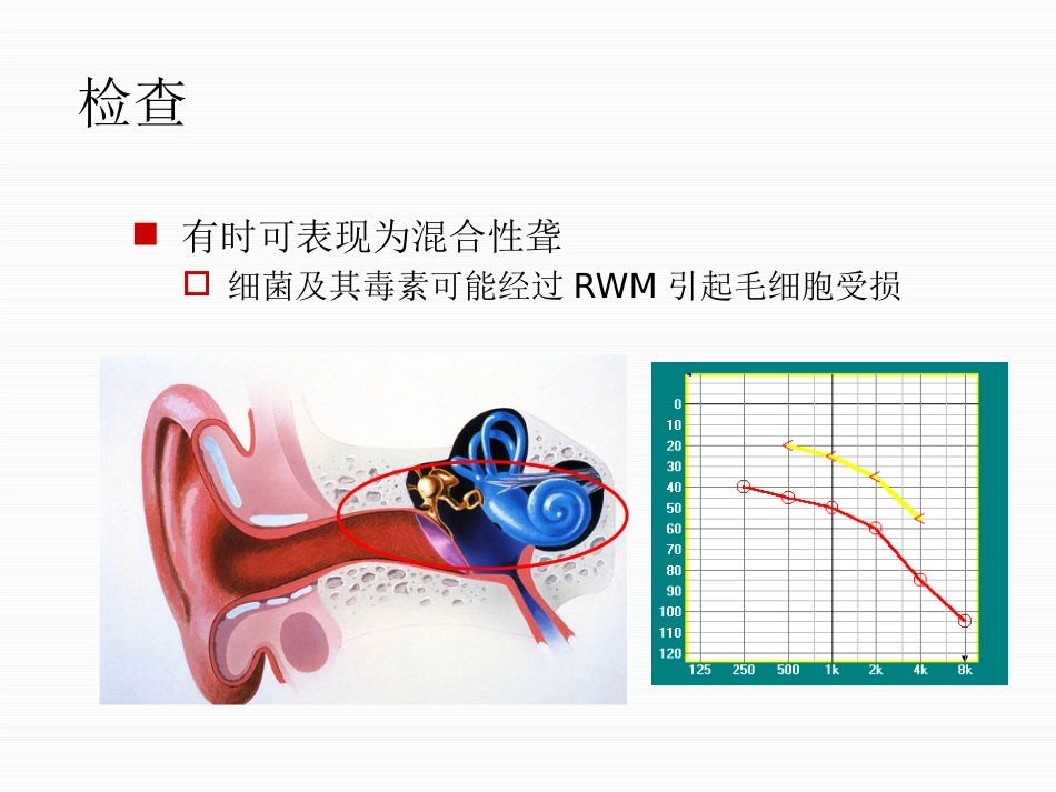 分泌性中耳炎中文_第14页