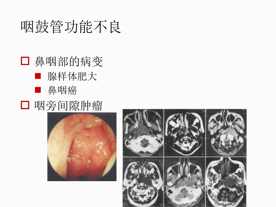 分泌性中耳炎中文_第6页