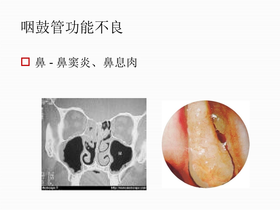 分泌性中耳炎中文_第8页
