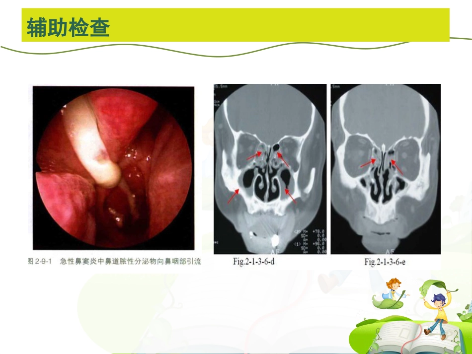 儿童鼻-鼻窦炎诊断和治疗建议_第10页