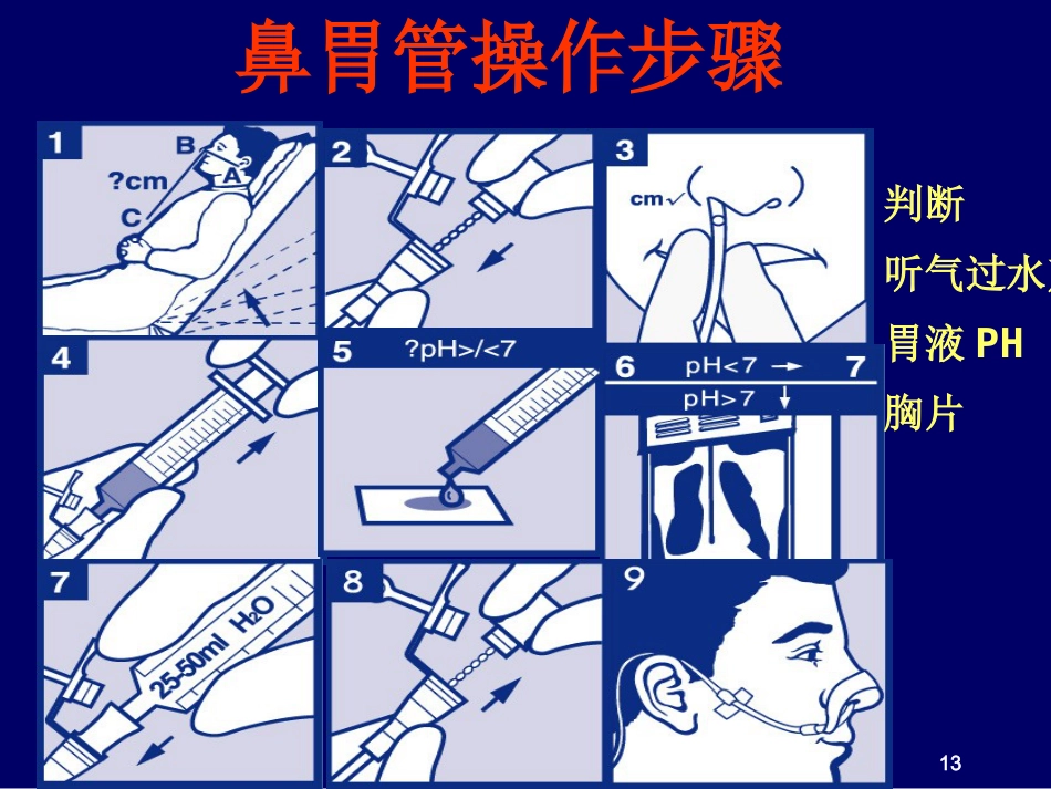 鼻胃肠管盲插方法及管理_第13页