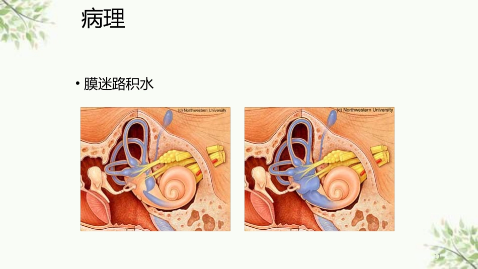常见内耳疾病护理课件_第11页