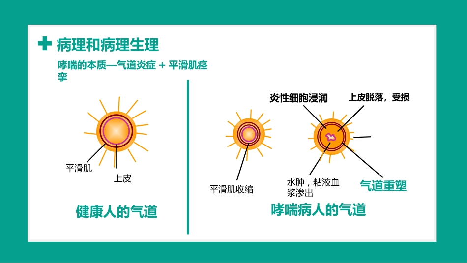 儿童哮喘1_第4页