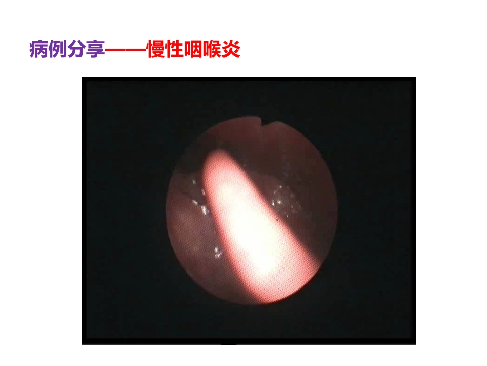 慢性咽喉炎与咽喉反流_第2页