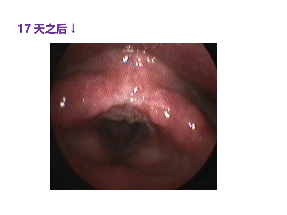 慢性咽喉炎与咽喉反流_第3页