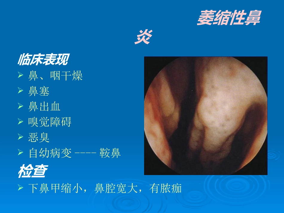 急慢性鼻炎_第12页