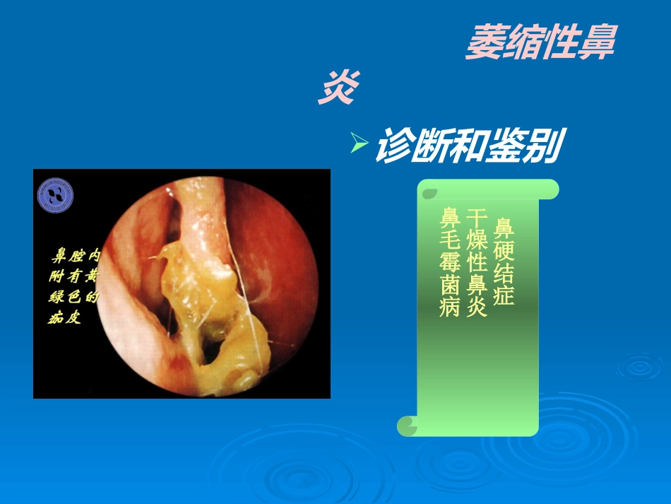 急慢性鼻炎_第13页