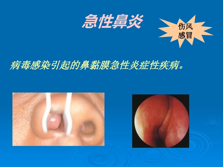 急慢性鼻炎_第3页