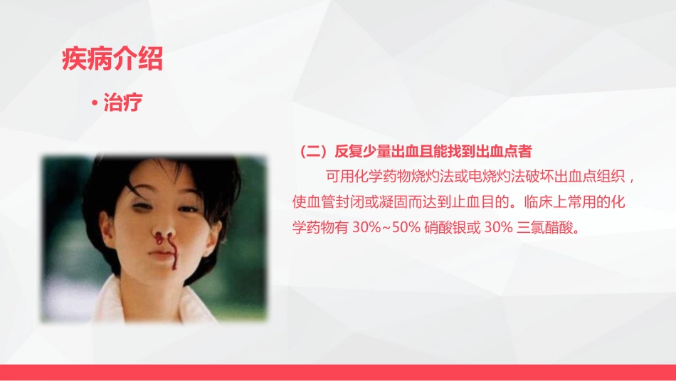 鼻出血的业务学习_第15页
