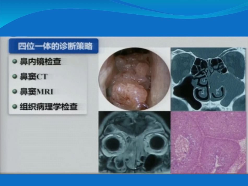 鼻内翻性乳头状瘤_第10页