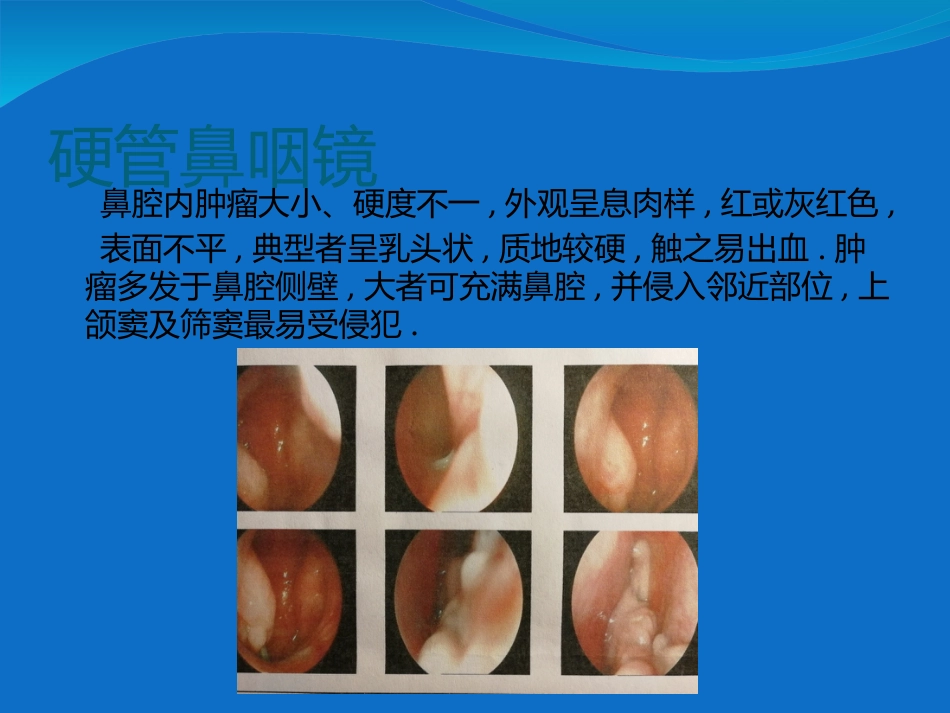 鼻内翻性乳头状瘤_第11页