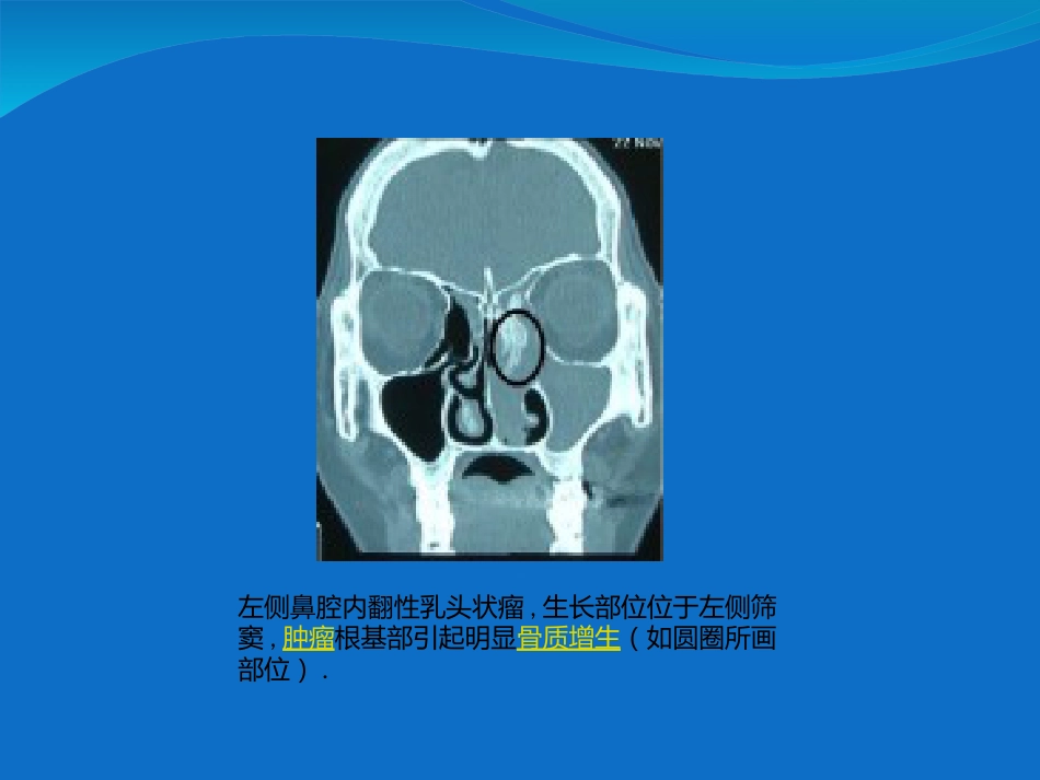 鼻内翻性乳头状瘤_第15页