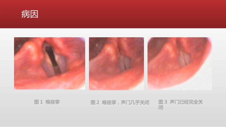 喉痉挛的紧急处理措施_第9页