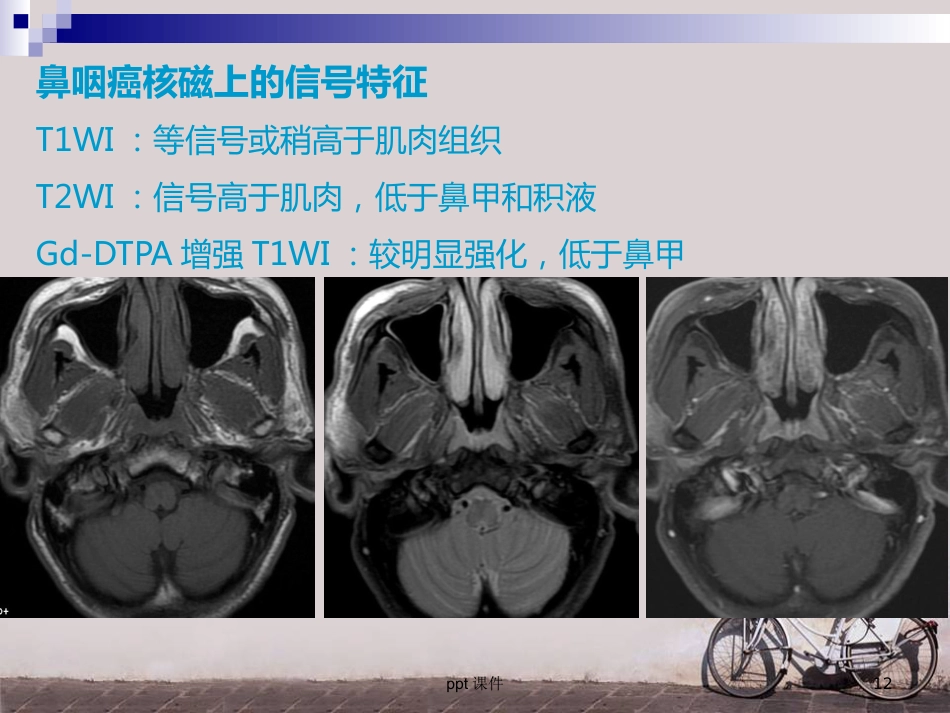 鼻咽癌调强放疗 ppt课件_第12页