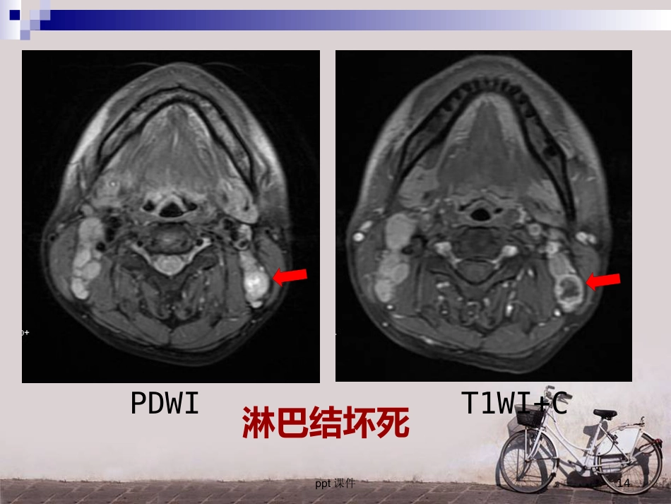 鼻咽癌调强放疗 ppt课件_第14页