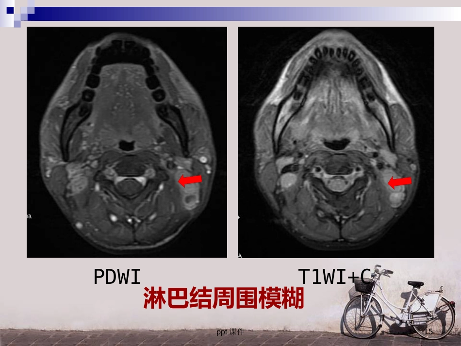 鼻咽癌调强放疗 ppt课件_第15页