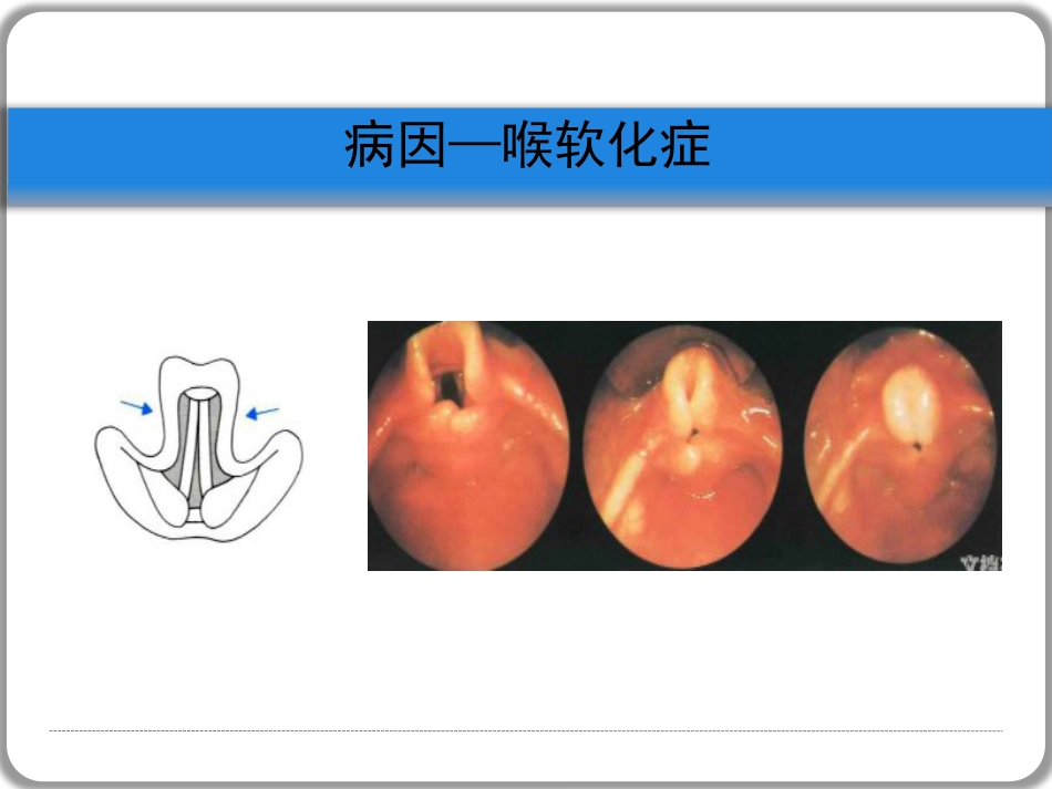 喉梗阻_第11页