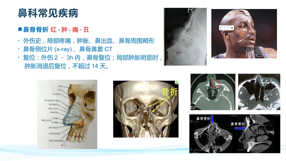 耳鼻喉常见疾病_第14页