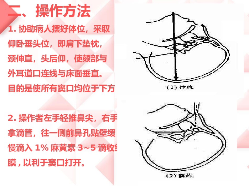 鼻负压置换的操作_第5页