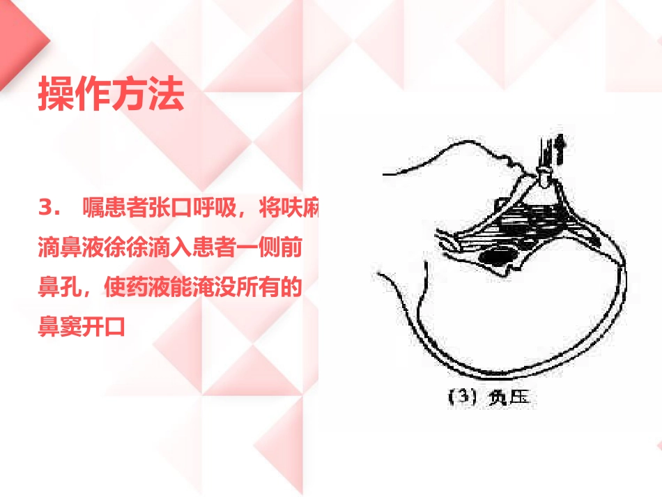 鼻负压置换的操作_第6页