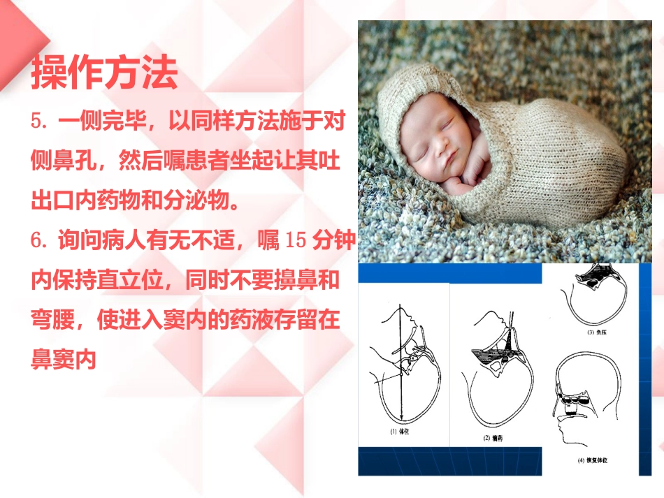 鼻负压置换的操作_第8页
