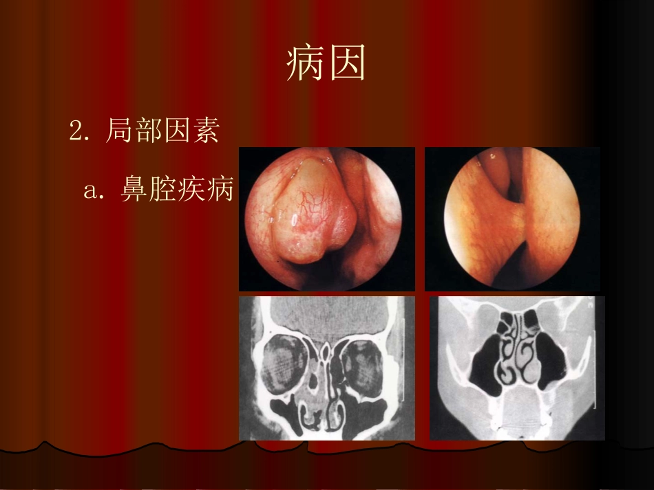 鼻窦炎性疾病_第8页