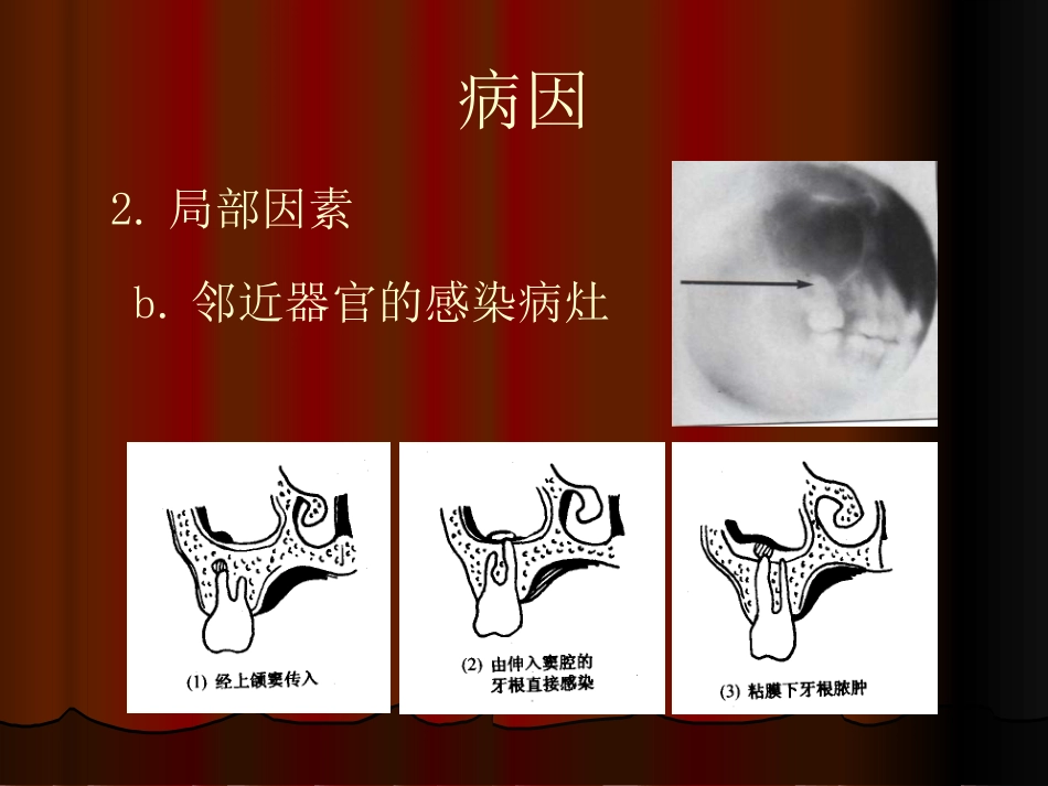 鼻窦炎性疾病_第9页