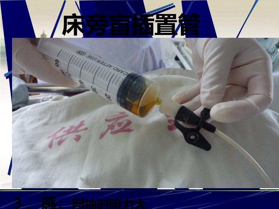鼻胃肠管盲插方法及管理 PPT_第12页