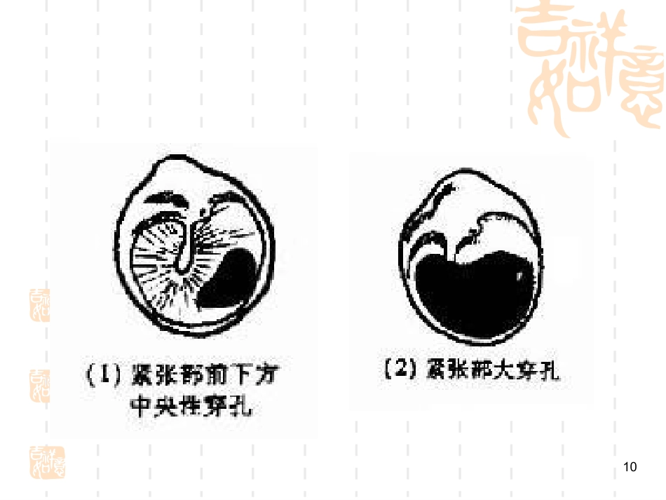 慢性化脓性中耳炎耳源性颅内外并发症系列PPT课件_第10页