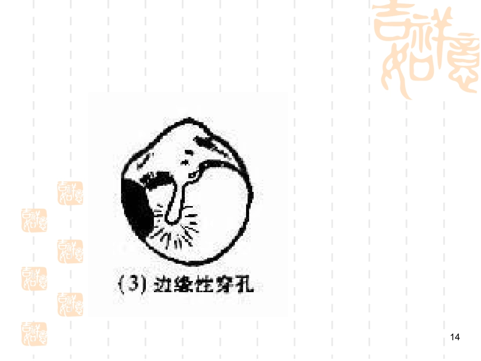 慢性化脓性中耳炎耳源性颅内外并发症系列PPT课件_第14页